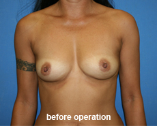 plastic-surgery-breast-augmentation